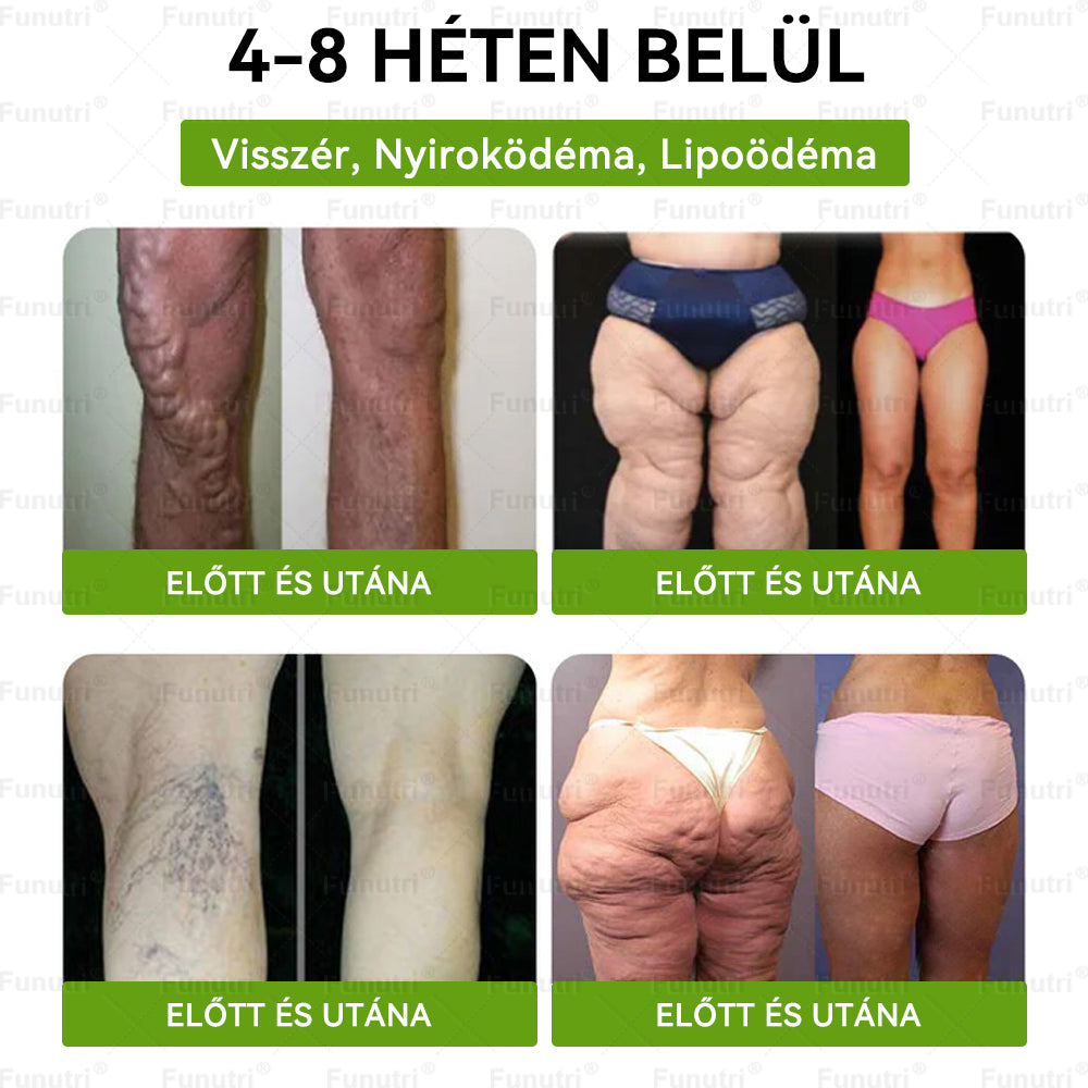 Magyar szakértők által ajánlott 💖Funutri® 10 az 1-ben anyagcsere-támogató karcsúsító nano mikro-tűs tapasz