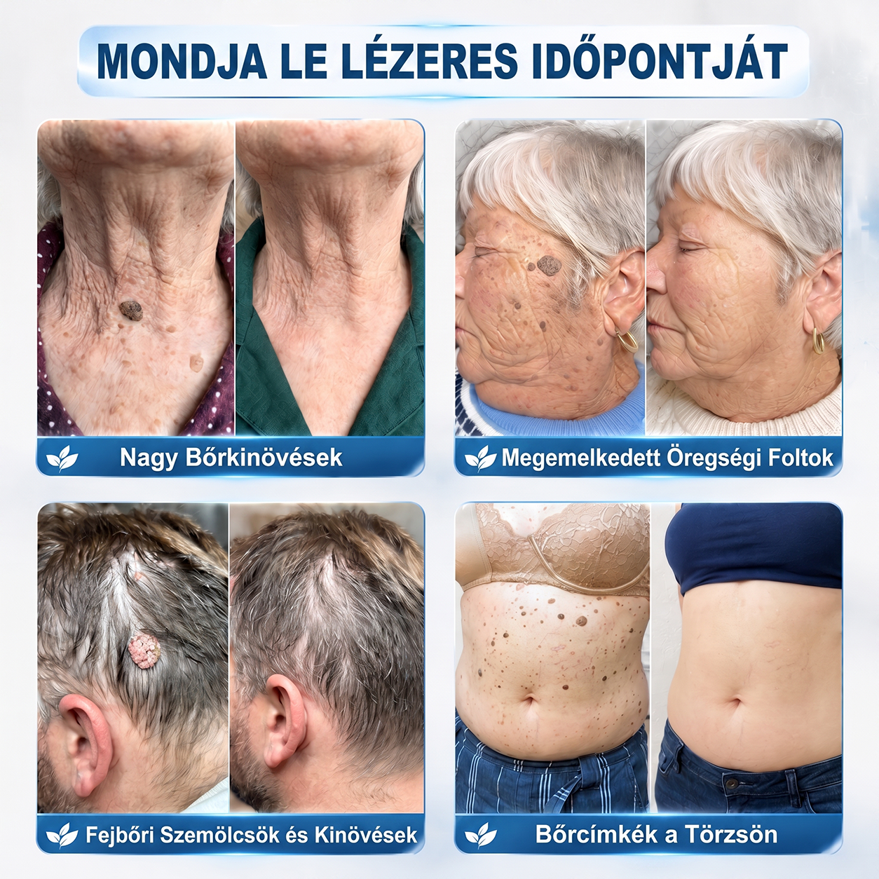 Hivatalos Márkabolt | Hiskin® 7 napos Szemölcseltávolító Roll-on Ápoló Folyadék (Fájdalommentes rollerball technológia, hegek nélkül) 🐬