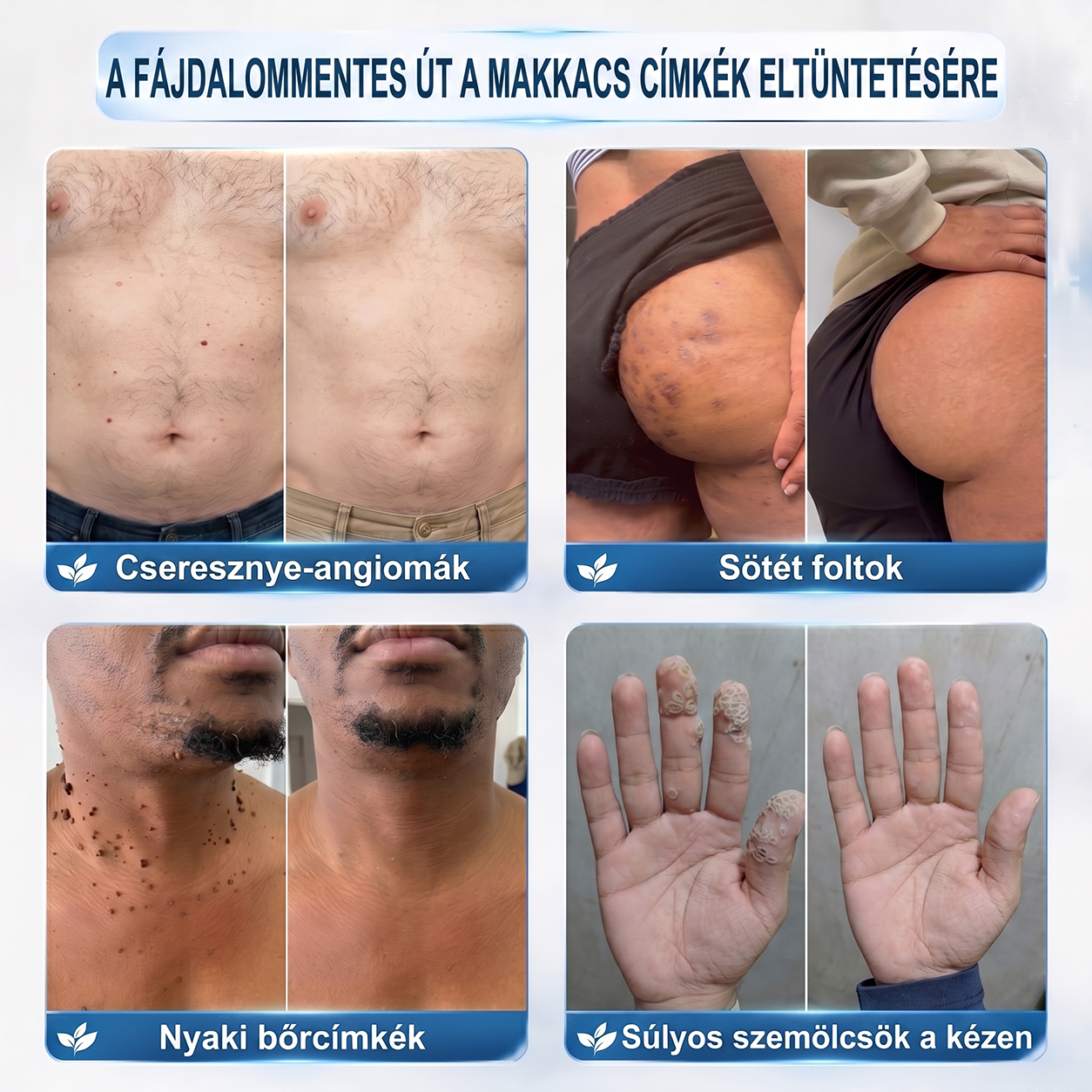 Hivatalos Márkabolt | Hiskin® 7 napos Szemölcseltávolító Roll-on Ápoló Folyadék (Fájdalommentes rollerball technológia, hegek nélkül) 🐬