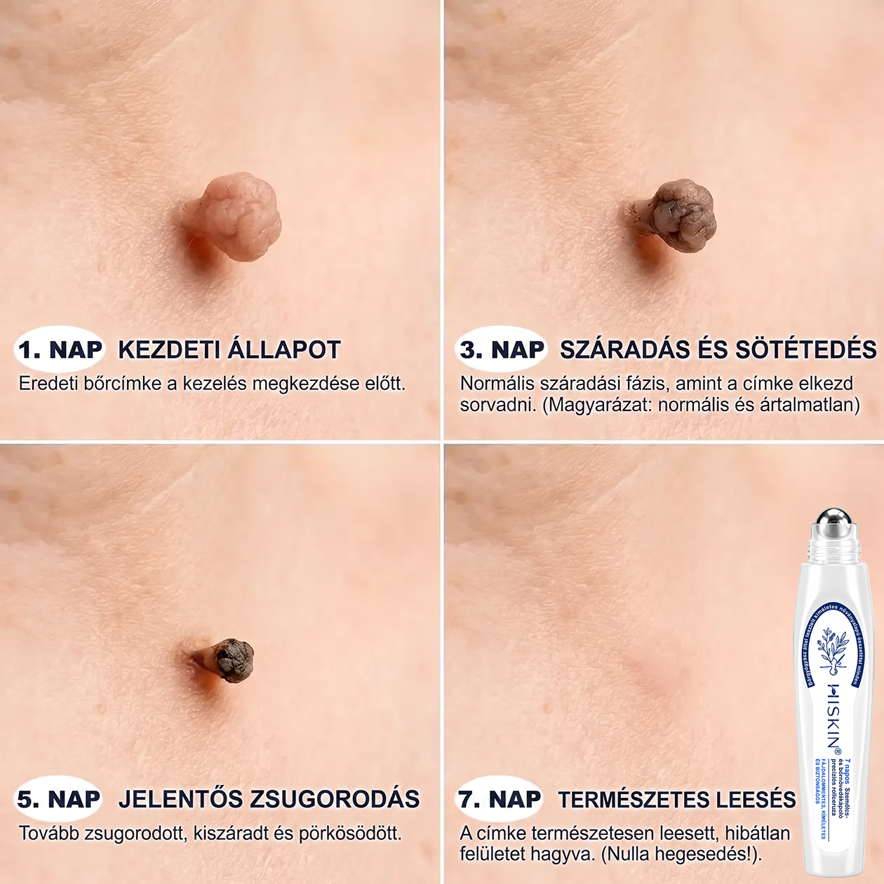 Hivatalos Márkabolt | Hiskin® 7 napos Szemölcseltávolító Roll-on Ápoló Folyadék (Fájdalommentes rollerball technológia, hegek nélkül) 🐬