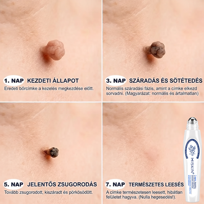 Hivatalos Márkabolt | Hiskin® 7 napos Szemölcseltávolító Roll-on Ápoló Folyadék (Fájdalommentes rollerball technológia, hegek nélkül) 🐬
